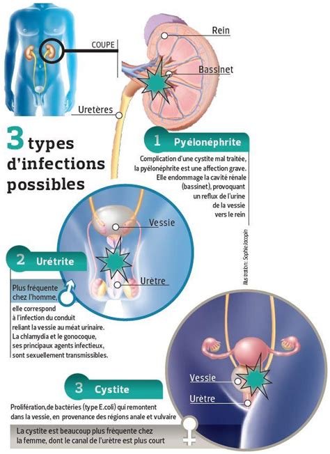 sodomie et infection urinaire|Sodomie et risques d’infection urinaire